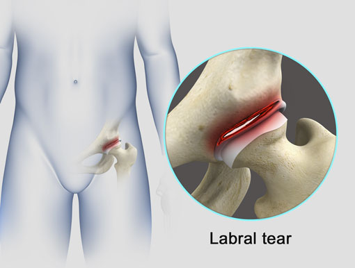 Labral Tear Repair
