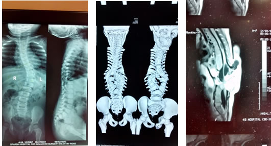 Spine Deformity  Surgery in Vadodara