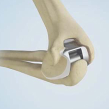 Elbow replacement
